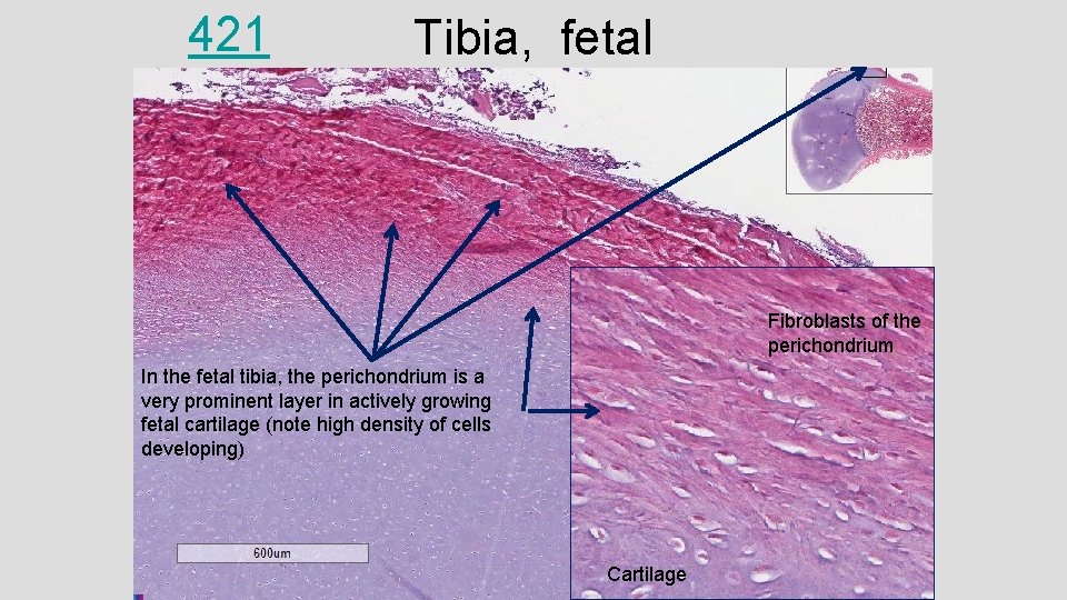 421 Tibia, fetal Fibroblasts of the perichondrium In the fetal tibia, the perichondrium is