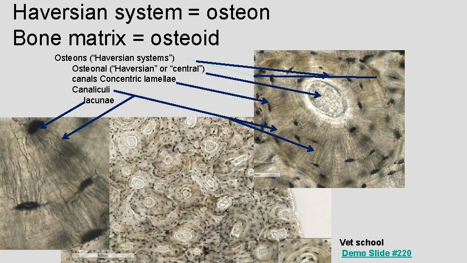 Haversian system = osteon Bone matrix = osteoid Osteons (“Haversian systems”) Osteonal (“Haversian” or