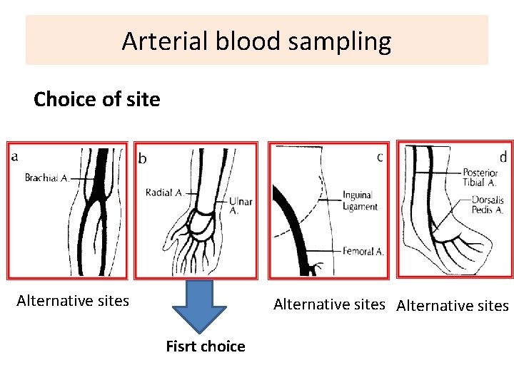 Arterial blood sampling Choice of site Alternative sites Fisrt choice 