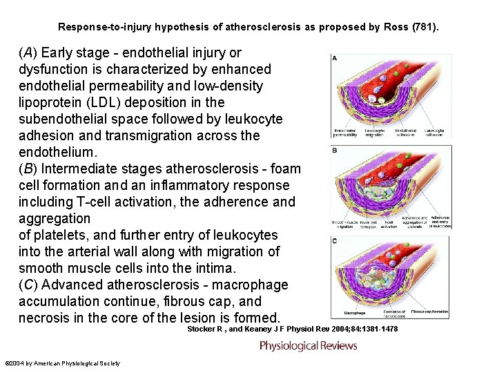 Response-to-injury hypothesis of atherosclerosis as proposed by Ross (781). (A) Early stage - endothelial