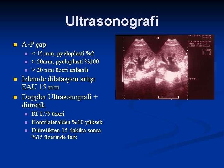 Ultrasonografi n A-P çap n n n < 15 mm, pyeloplasti %2 > 50