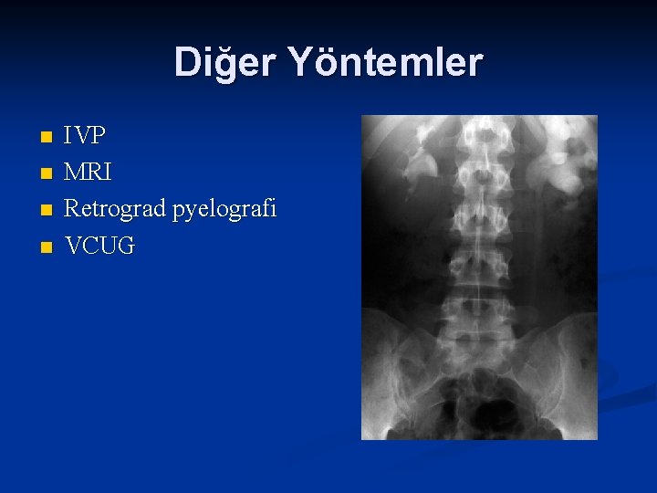 Diğer Yöntemler n n IVP MRI Retrograd pyelografi VCUG 