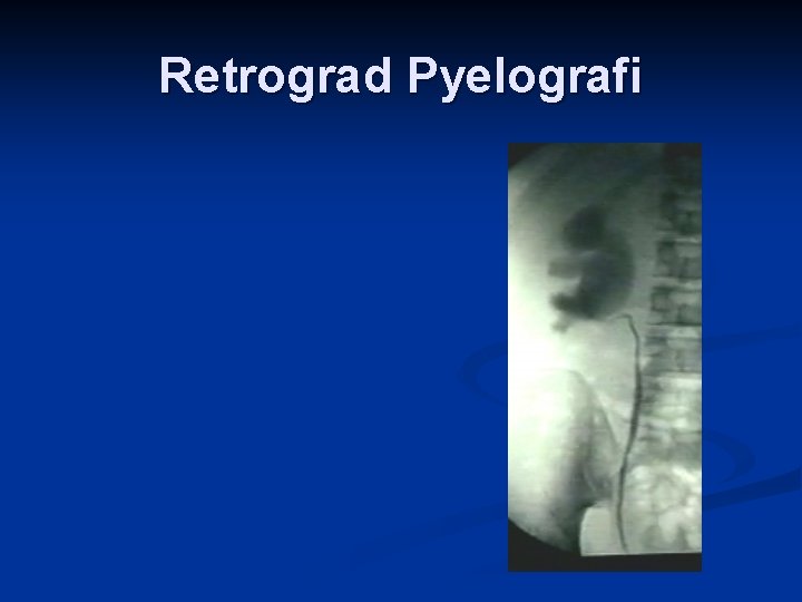 Retrograd Pyelografi 