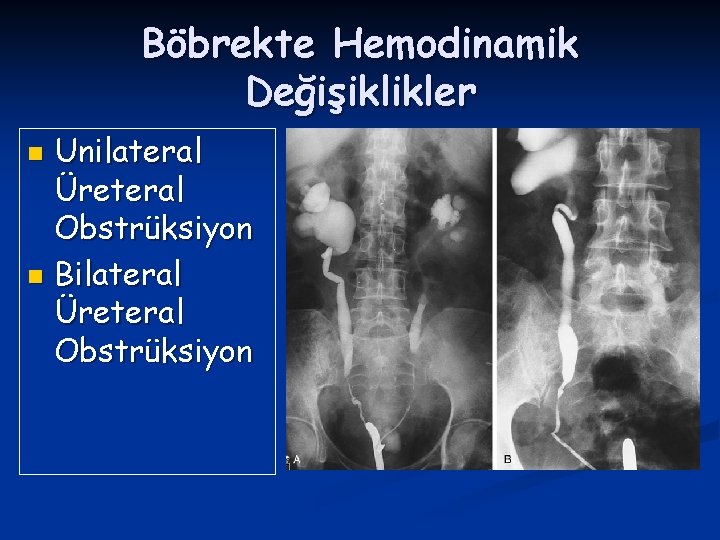 Böbrekte Hemodinamik Değişiklikler Unilateral Üreteral Obstrüksiyon n Bilateral Üreteral Obstrüksiyon n 