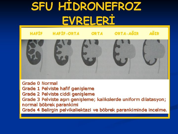 SFU HİDRONEFROZ EVRELERİ HAFİF-ORTA-AĞIR Grade 0 Normal Grade 1 Pelviste hafif genişleme Grade 2