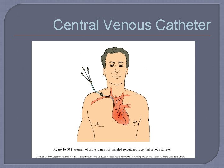 Central Venous Catheter 