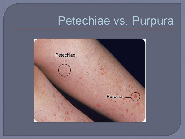 Petechiae vs. Purpura 