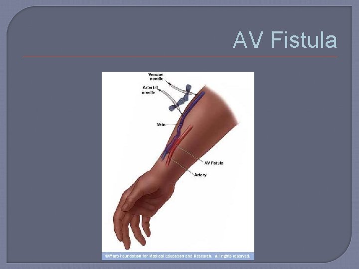 AV Fistula 