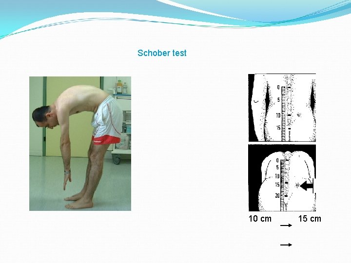 Schober test 10 cm 15 cm 