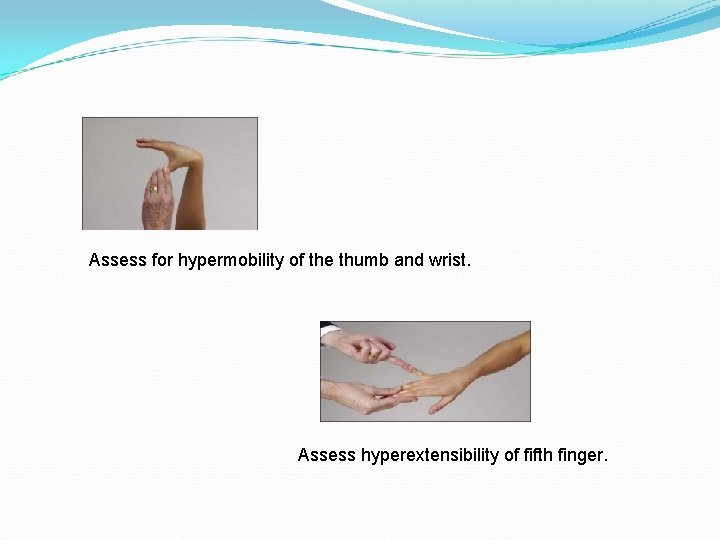 Assess for hypermobility of the thumb and wrist. Assess hyperextensibility of fifth finger. 