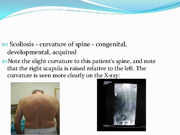  Scoliosis - curvature of spine - congenital, developmental, acquired Note the slight curvature