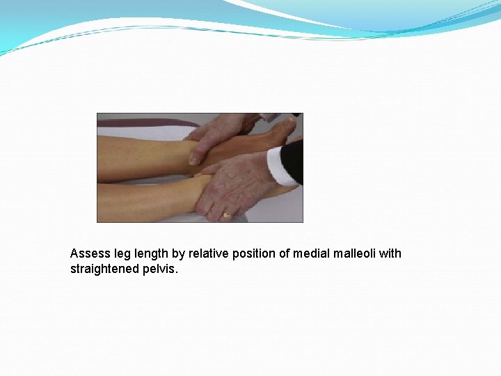 Assess leg length by relative position of medial malleoli with straightened pelvis. 