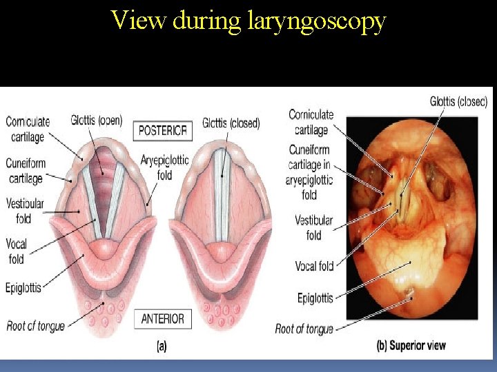 View during laryngoscopy 