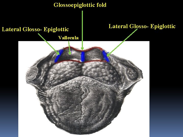 Glossoepiglottic fold Lateral Glosso- Epiglottic Vallecula Lateral Glosso- Epiglottic 