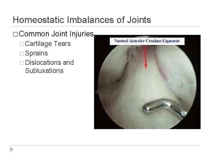 Homeostatic Imbalances of Joints � Common Joint Injuries � Cartilage Tears � Sprains �