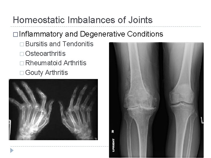 Homeostatic Imbalances of Joints � Inflammatory � Bursitis and Degenerative Conditions and Tendonitis �