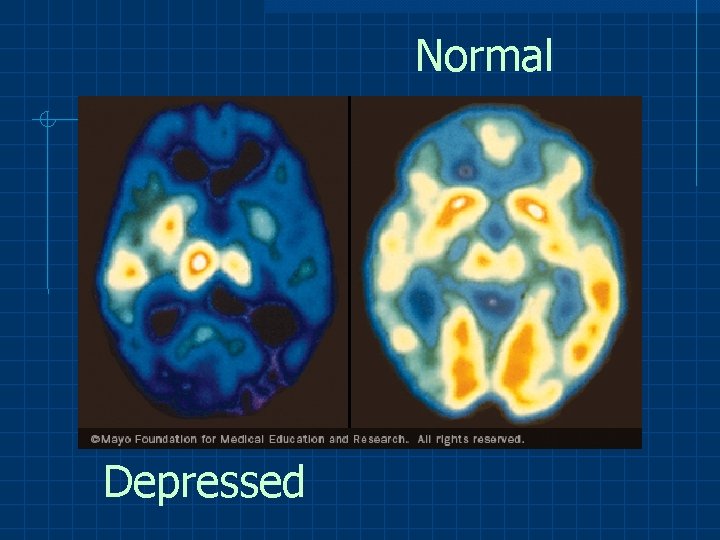 Normal Depressed 