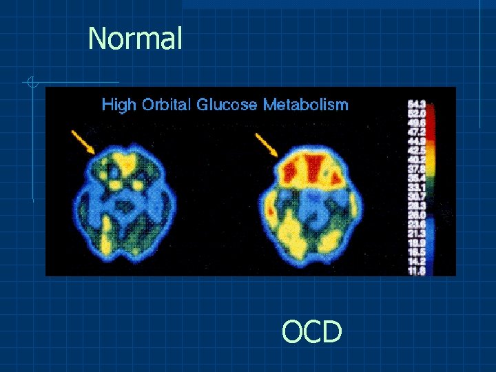 Normal OCD 