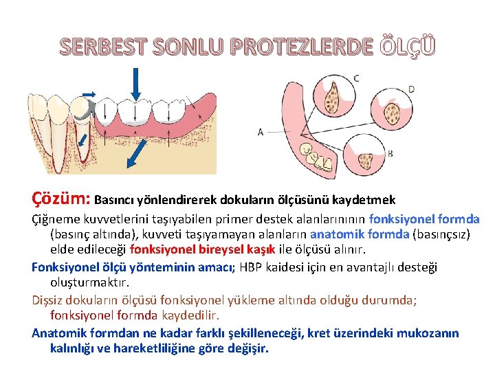 SERBEST SONLU PROTEZLERDE ÖLÇÜ Çözüm: Basıncı yönlendirerek dokuların ölçüsünü kaydetmek Çiğneme kuvvetlerini taşıyabilen primer