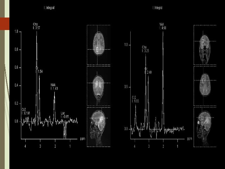 MRS of affected white matter with TE=30 MRS of normal anterior white matter with