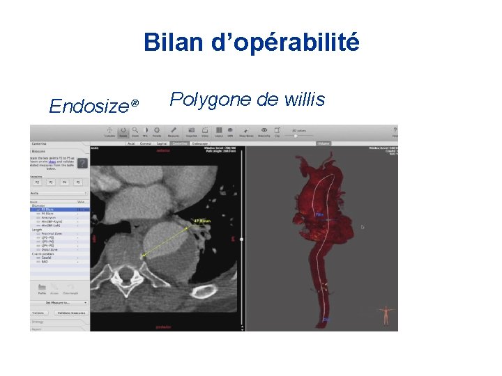 Bilan d’opérabilité Endosize® Polygone de willis 