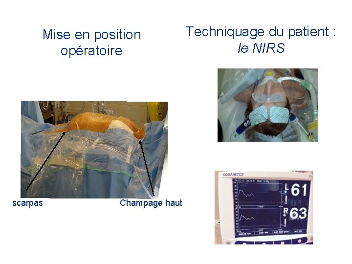 Mise en position opératoire scarpas Champage haut Techniquage du patient : le NIRS 