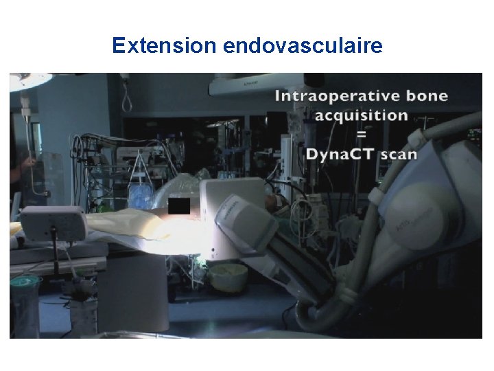 Extension endovasculaire 