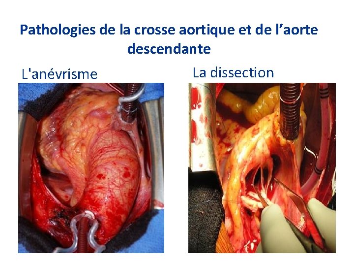 Pathologies de la crosse aortique et de l’aorte descendante L'anévrisme La dissection 