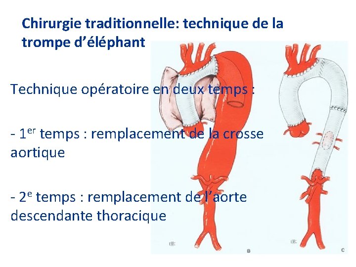 Chirurgie traditionnelle: technique de la trompe d’éléphant Technique opératoire en deux temps : -