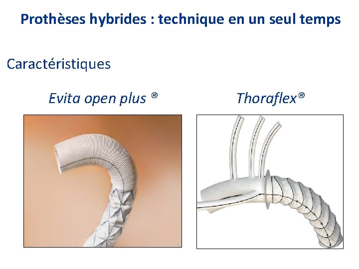 Prothèses hybrides : technique en un seul temps Caractéristiques Evita open plus ® Thoraflex®