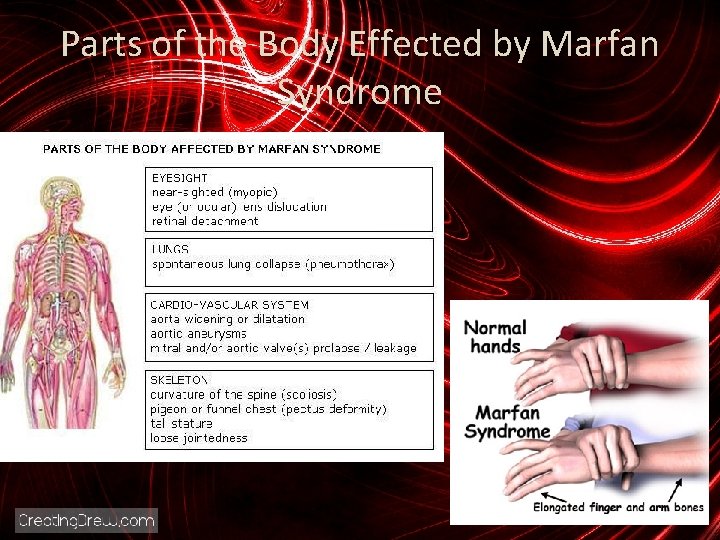 Parts of the Body Effected by Marfan Syndrome 