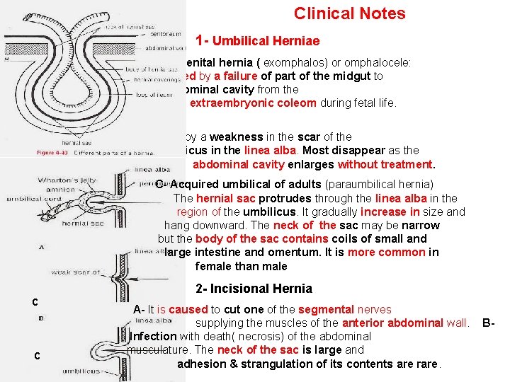 Clinical Notes 1 - Umbilical Herniae A- Congenital hernia ( exomphalos) or omphalocele: It