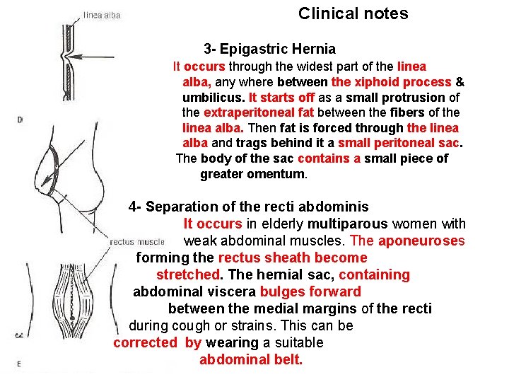 Clinical notes 3 - Epigastric Hernia It occurs through the widest part of the