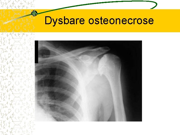 Dysbare osteonecrose 