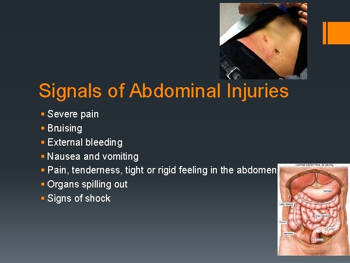 Signals of Abdominal Injuries § Severe pain § Bruising § External bleeding § Nausea