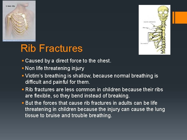 Rib Fractures § Caused by a direct force to the chest. § Non life