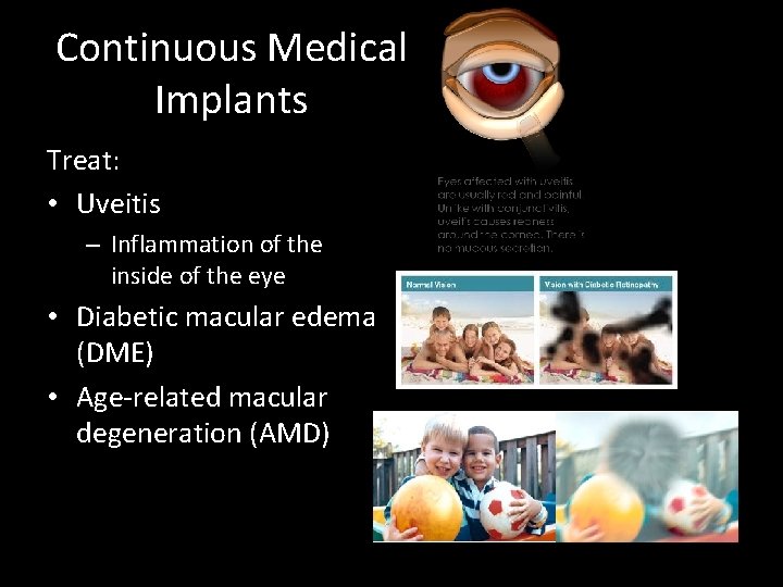 Continuous Medical Implants Treat: • Uveitis – Inflammation of the inside of the eye