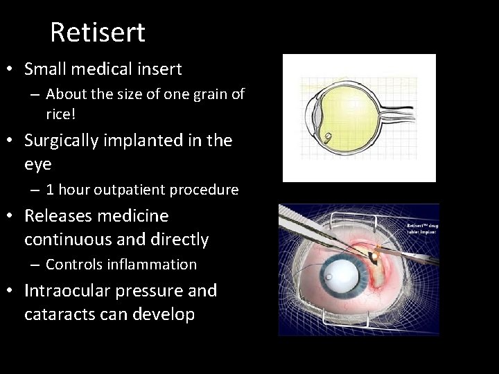 Retisert • Small medical insert – About the size of one grain of rice!