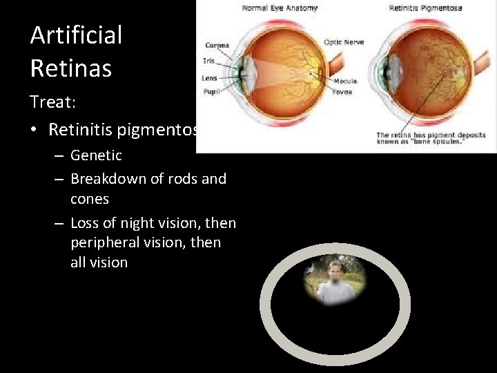 Artificial Retinas Treat: • Retinitis pigmentosa – Genetic – Breakdown of rods and cones