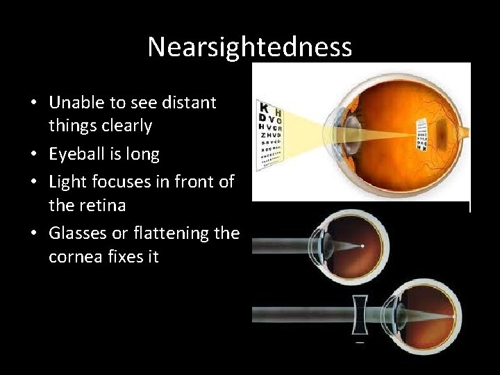 Nearsightedness • Unable to see distant things clearly • Eyeball is long • Light