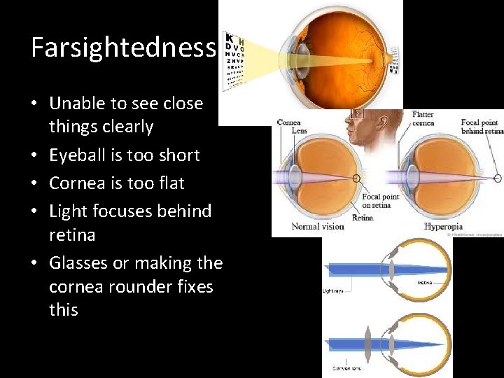 Farsightedness • Unable to see close things clearly • Eyeball is too short •