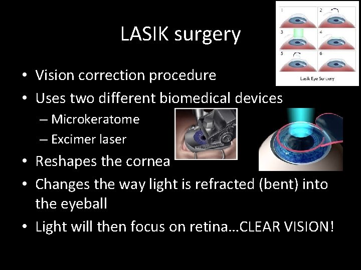 LASIK surgery • Vision correction procedure • Uses two different biomedical devices – Microkeratome