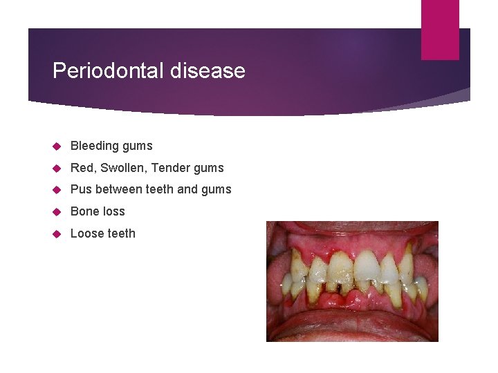 Periodontal disease Bleeding gums Red, Swollen, Tender gums Pus between teeth and gums Bone