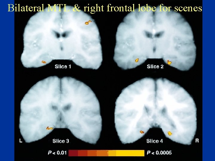 Bilateral MTL & right frontal lobe for scenes 