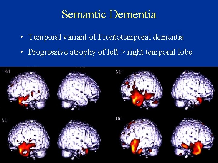 Semantic Dementia • Temporal variant of Frontotemporal dementia • Progressive atrophy of left >