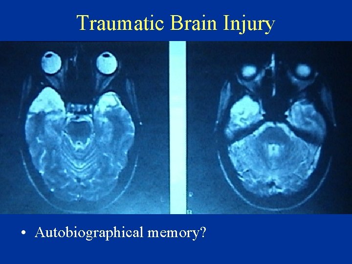 Traumatic Brain Injury • Autobiographical memory? 