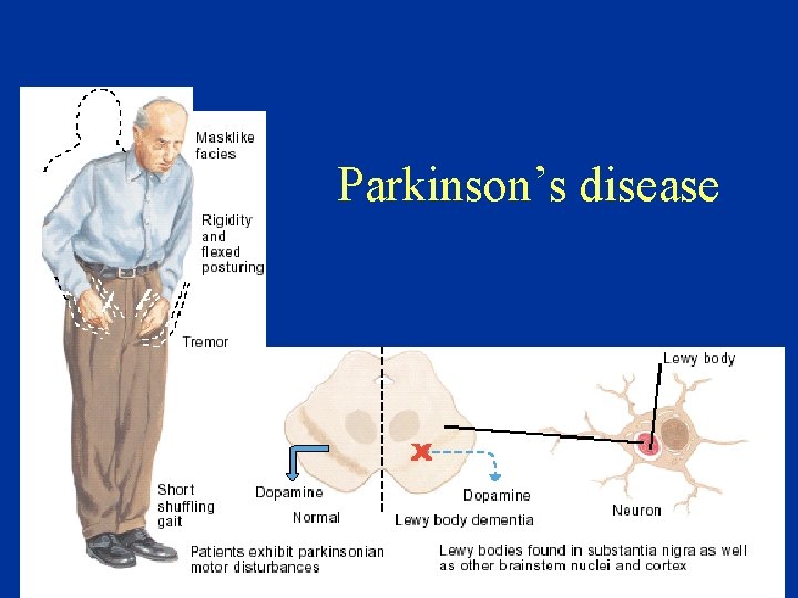 Parkinson’s disease 