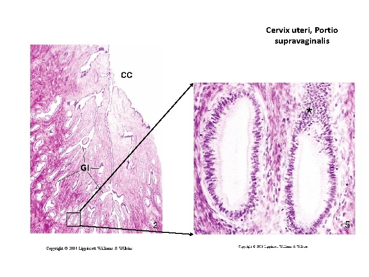 Cervix uteri, Portio supravaginalis 