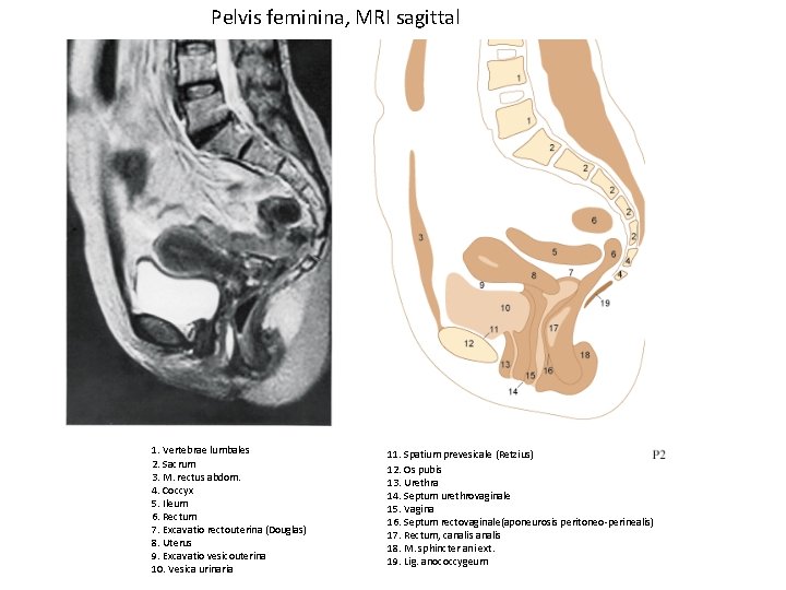 Pelvis feminina, MRI sagittal 1. Vertebrae lumbales 2. Sacrum 3. M. rectus abdom. 4.