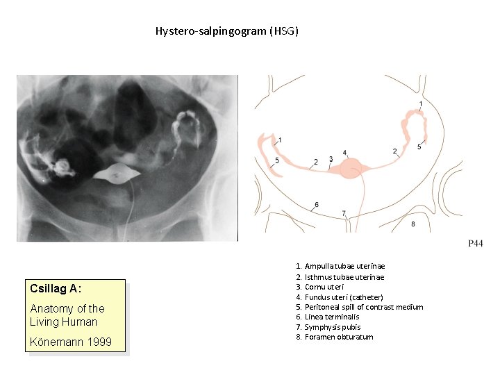 Hystero-salpingogram (HSG) Csillag A: Anatomy of the Living Human Könemann 1999 1. Ampulla tubae
